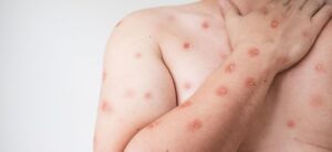 Primeiro caso de Mpox em 2026 é confirmado em Porto Alegre