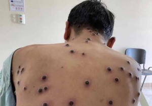 Governo da Bahia desmente informações sobre casos confirmados de Mpox