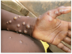 Bahia confirma primeiros registros de Mpox em 2026